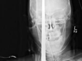 Φωτογραφία για Σοκ στο Αγρίνιο: Μοναδικός στα χρονικά ο τραυματισμός- Η βέργα του ψαροντούφεκου του διαπέρασε το κρανίο